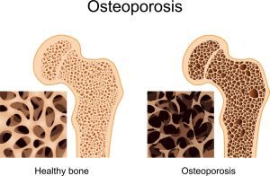 osteoporosis-300x196